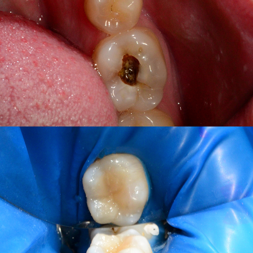 Профессиональная гигиена полости рта