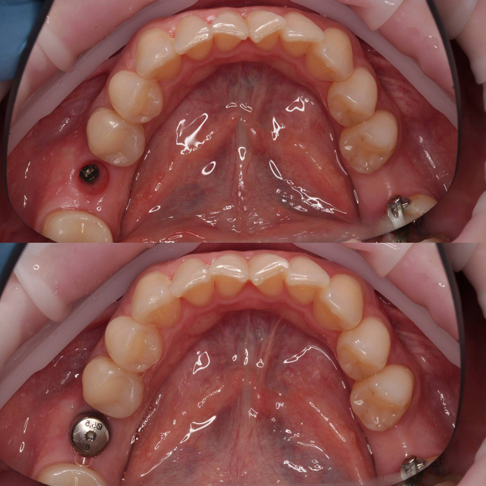 Одиночная имплантация