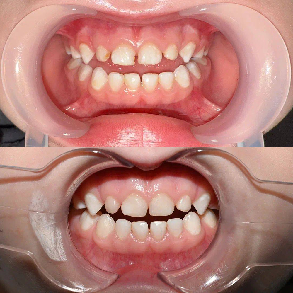 Профессиональная гигиена полости рта