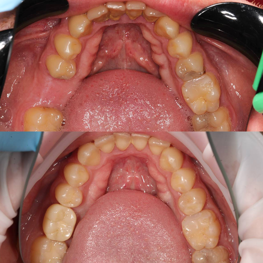 Одиночная имплантация