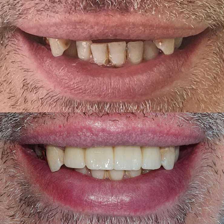 Протезирование на имплантах передних зубов