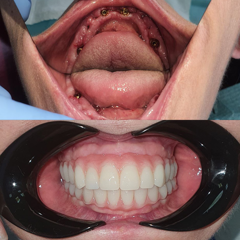 Имплантация и протезирование беззубой челюсти