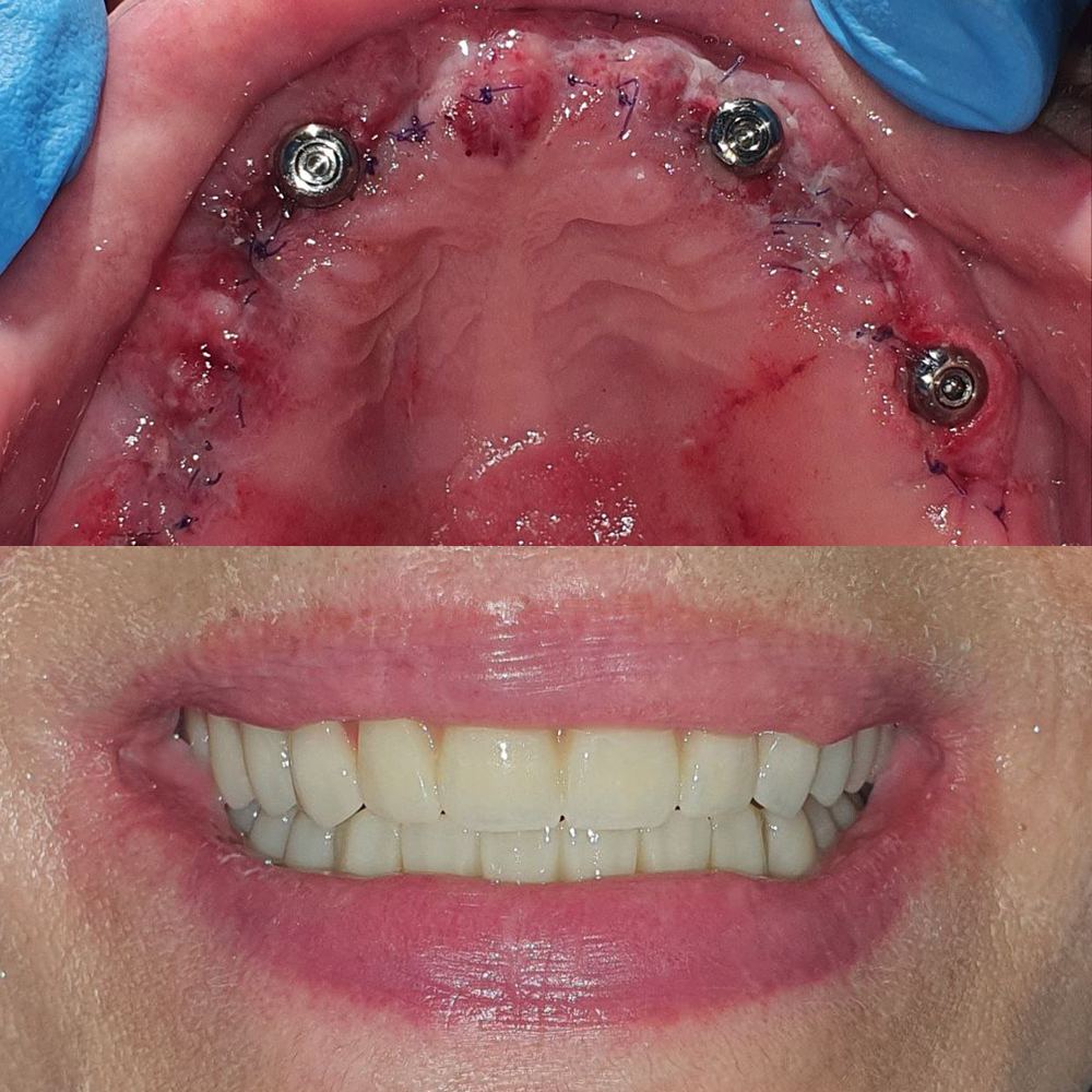 Имплантация и протезирование беззубой челюсти