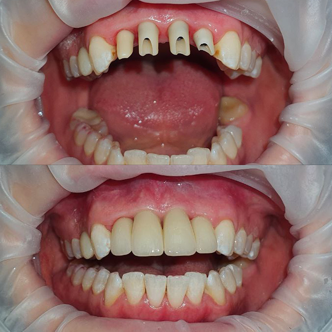 Протезирование на имплантах