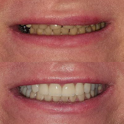 Тотальная работа на верхней и нижней челюстях